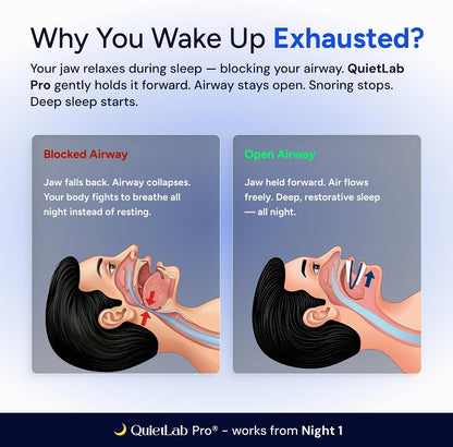 QuietLab Pro® Mouth Guard for Sleeping - Anti-Snoring Device, Custom Fit